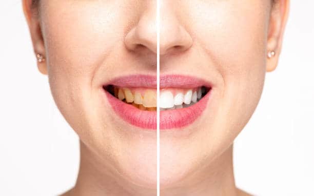 Teeth Whitening Milton Keynes Buckinghamshire