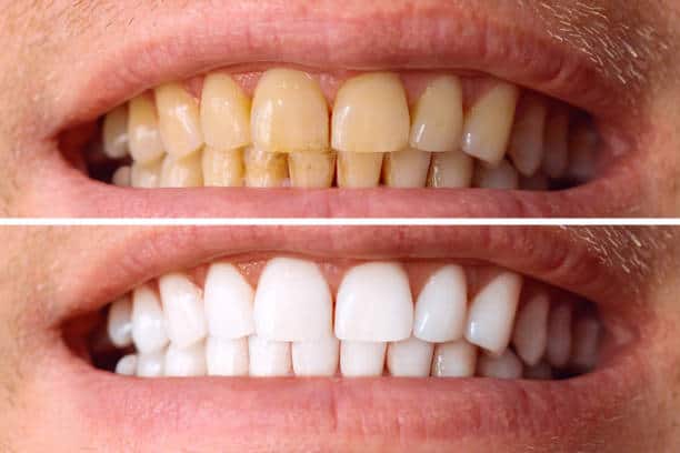 Laser White For Ever Bright – Get a Brighter, Whiter Smile with LA Teeth Whitening Buckinghamshire