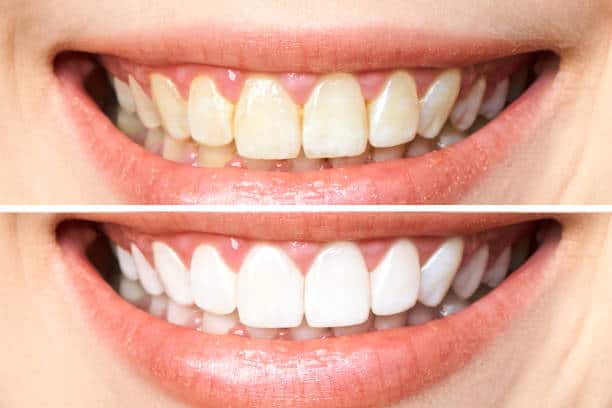 Achieve a Dazzling Smile for Your Special Day: A Guide to Wedding Teeth Whitening Buckinghamshire