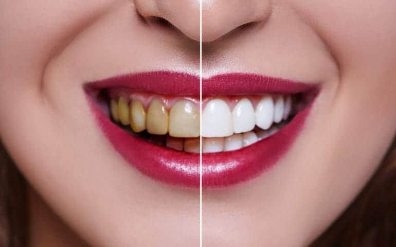 Teeth Whitening Ascot Windsor Buckinghamshire