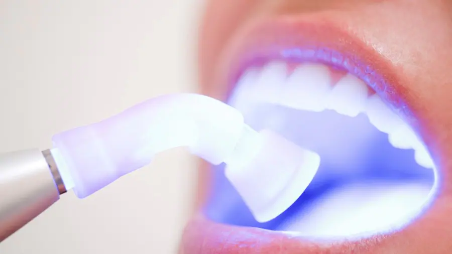 Teeth Whitening Aylesbury Buckinghamshire