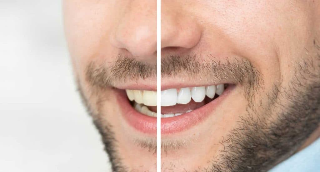 Teeth Whitening Bedfordshire Buckinghamshire