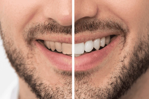 Do you want whiter teeth in just 1 hour? Book your zoom teeth whitening Buckinghamshire today! Buckinghamshire