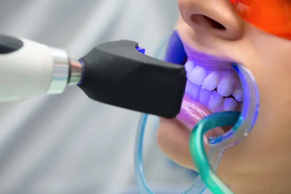 Will I See Immediate Results from Lazer Teeth Whitening Buckinghamshire