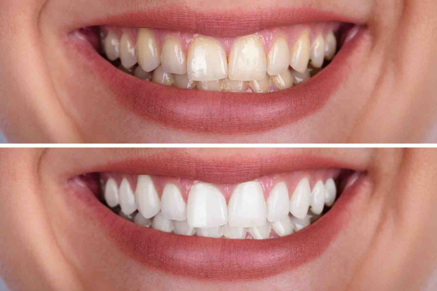 Can Teeth Whitening Fix Uneven Colour — Or Will It Just Make It Worse Buckinghamshire
