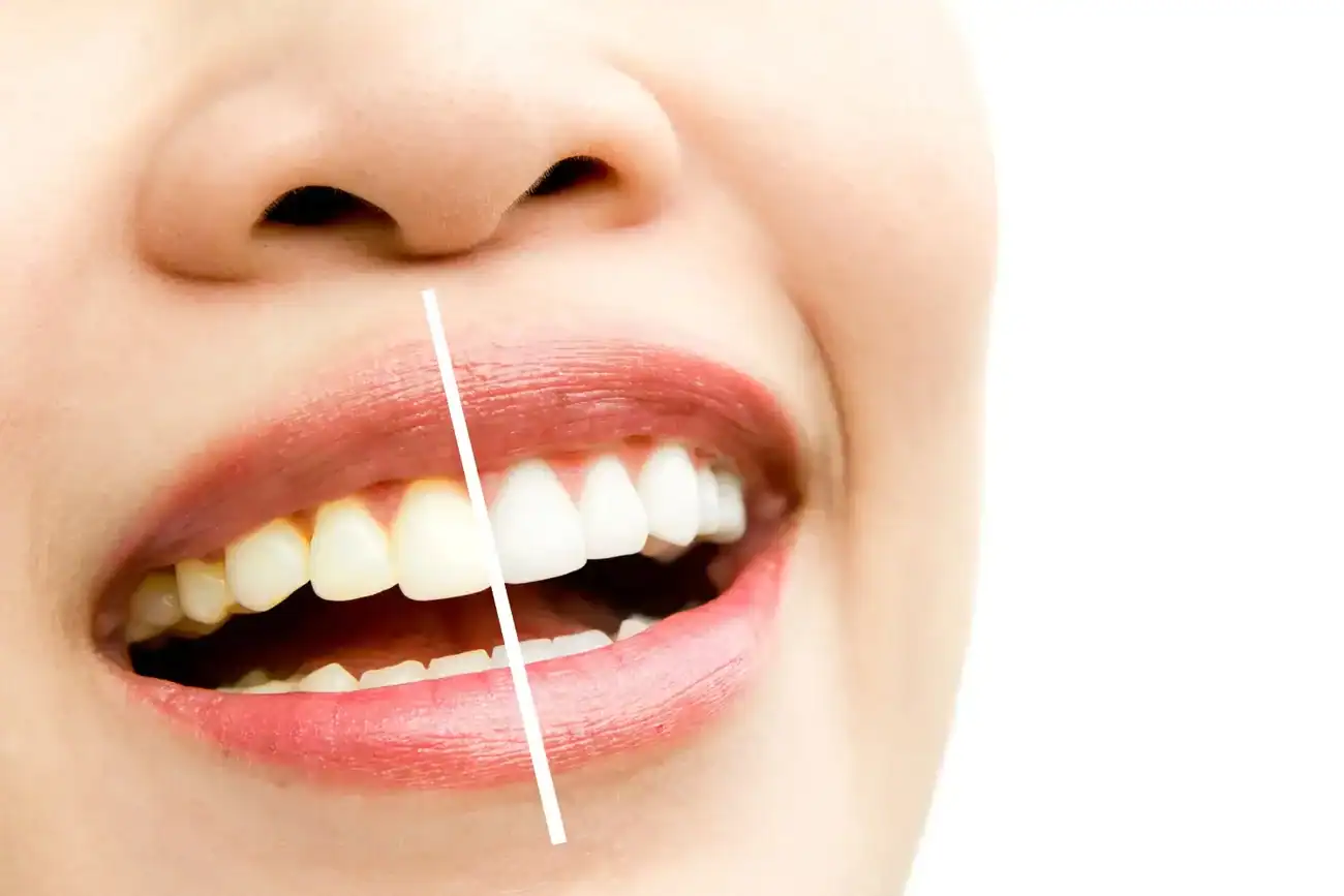 How Can I Protect My Teeth Before and After Whitening with Enamel Loss Buckinghamshire